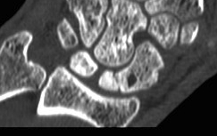 Scaphoid AVN CT